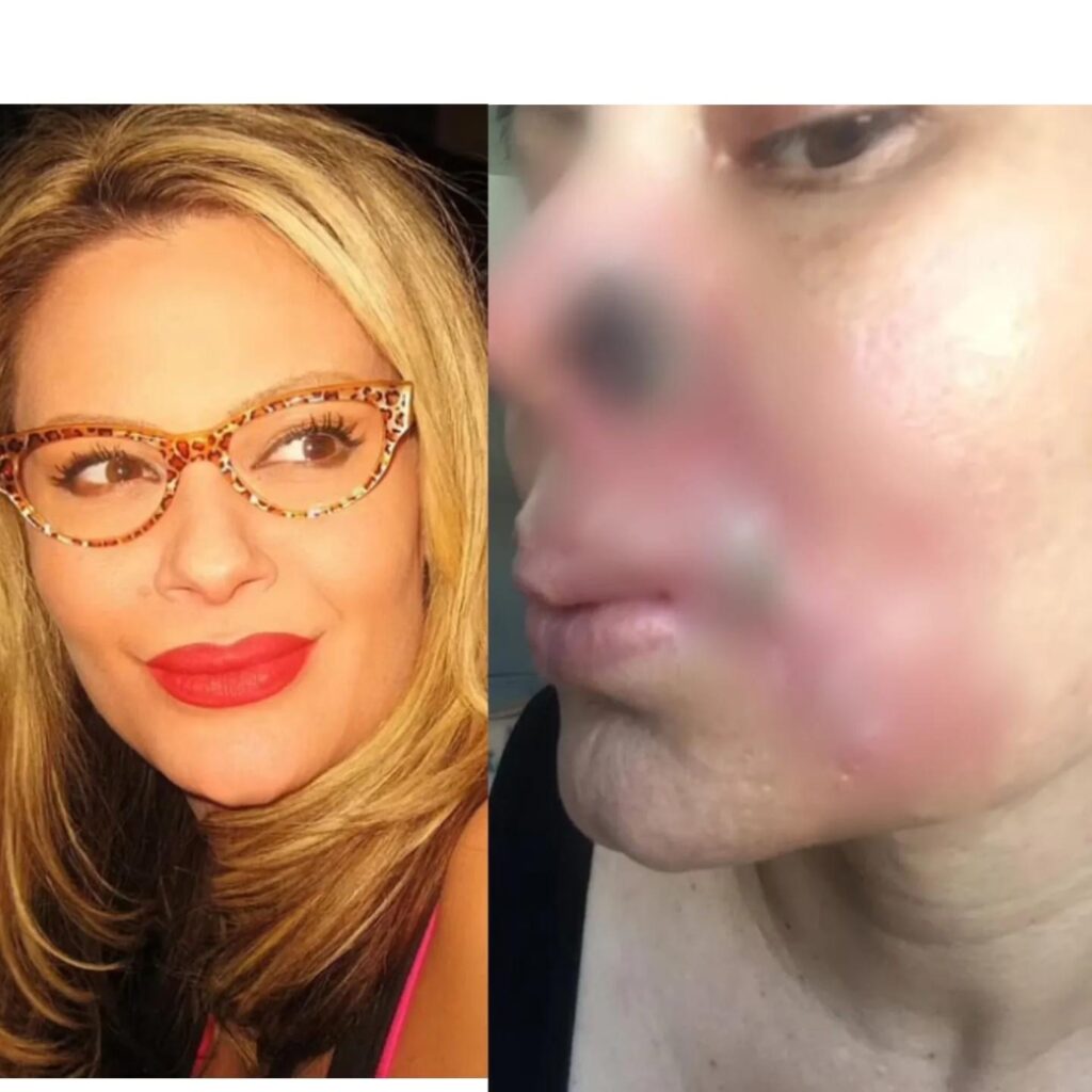 Lady’s nostril falls off after getting fillers to hide ageing lines